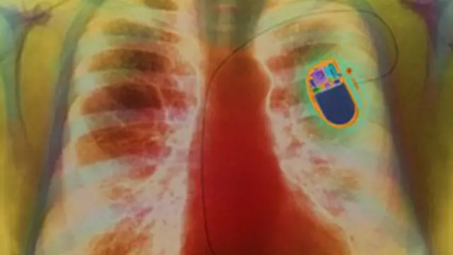 पेसमेकर