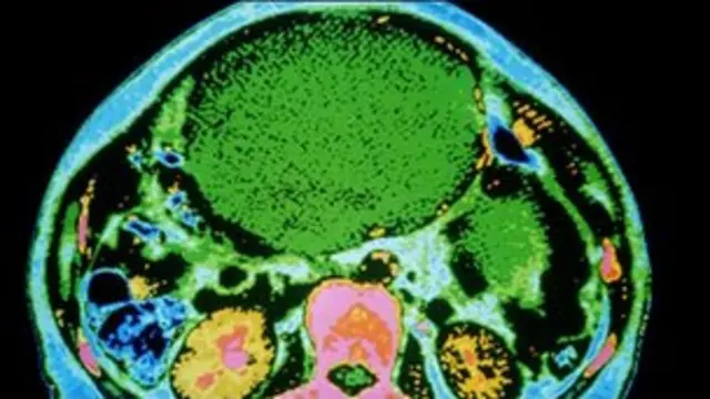 بیضہ دانی کا کینسر برطانیہ کی خواتین میں پانچواں سب سے زیادہ پائے جانے والا کینسر ہے۔