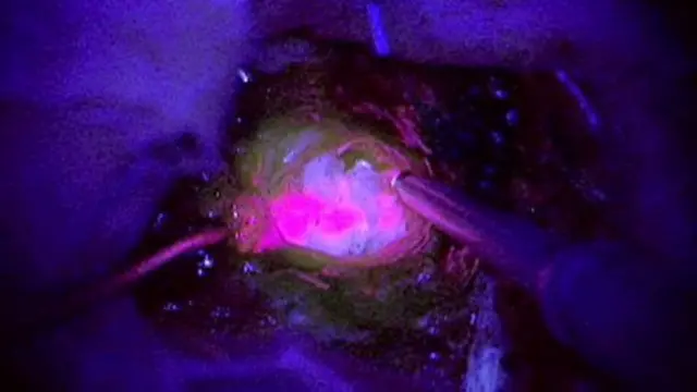 El tumor brilla bajo la luz ultravioleta