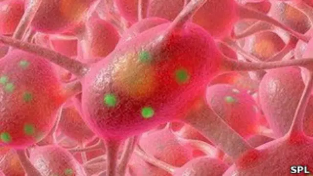 الشلل الرعاش