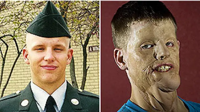 Mitch Hunter, antes y después del accidente.