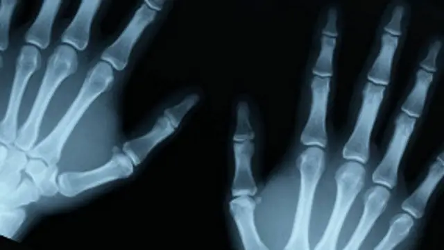 La regeneración de huesos a partir del uso de la tecnología