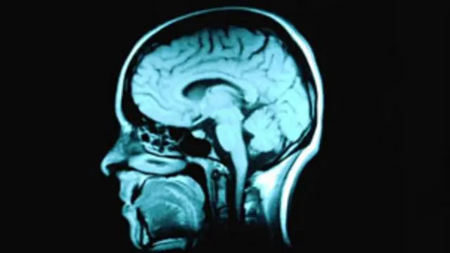 اسکن مغناطیسی از مغز