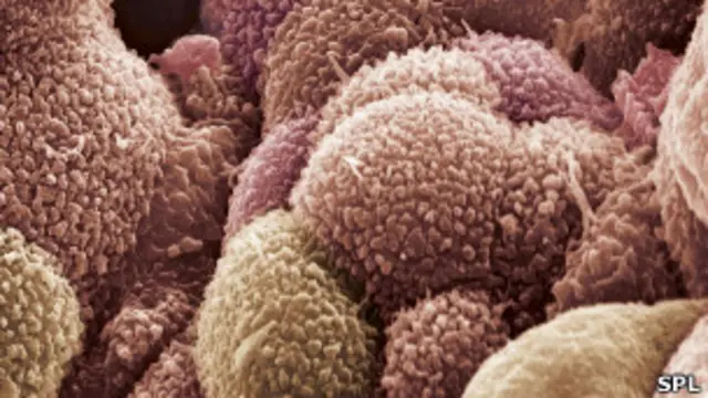 تصل نسبة النجاة من المرض إلى 90 في المئة حال الاكتشاف المبكر لسرطان المبيض