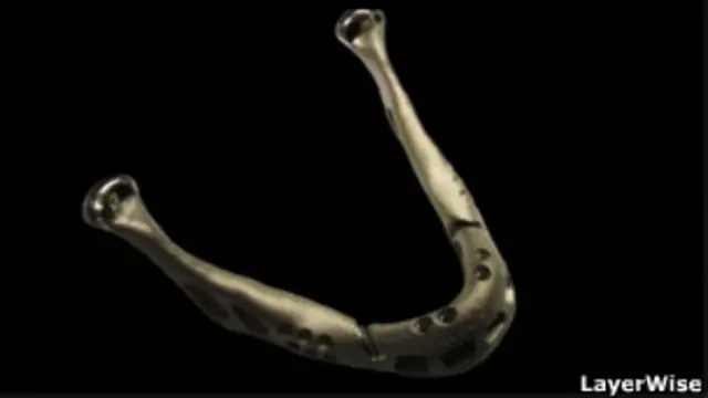 El implante de una copia 3D hace que la operación sea más corta porque la pieza es más exacta.