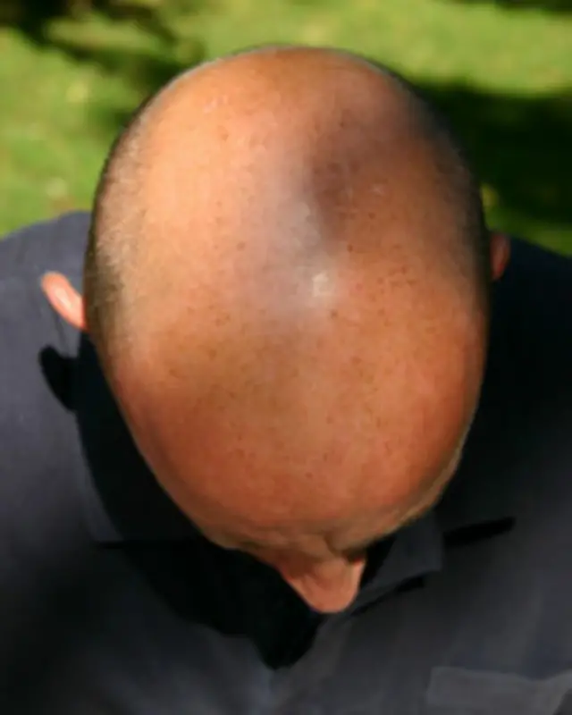 Kişilərdə keçəlləşməyə cavabdeh protein müəyyən edilib