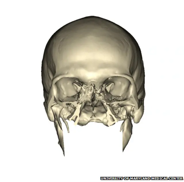 Первая часть операции состояла в удалении поврежденных участков кожи на голове, а также ранее восстановленных носа и челюстей с помощью тканей, полученных в других частях организма.