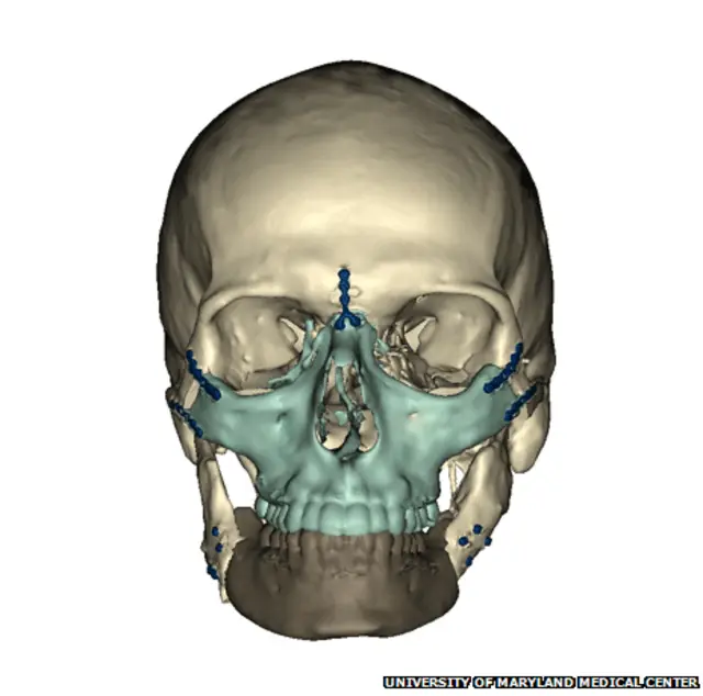 Хирурги при помощи компьютерного моделирования пересадили ткани части лица у донора, часть языка, зубы и челюсти. Также были пересажены мимические мышцы и лицевые нервы.