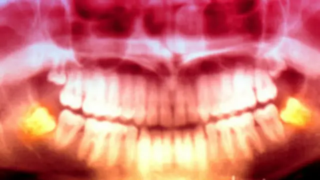 radiografía de los dientes