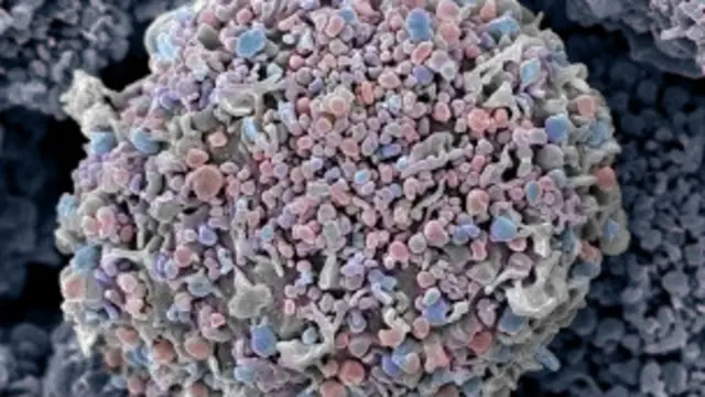 Célula cancerosa de mama