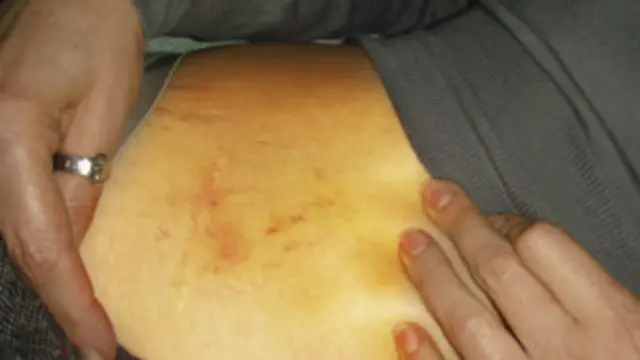 Синяки на теле заключенной