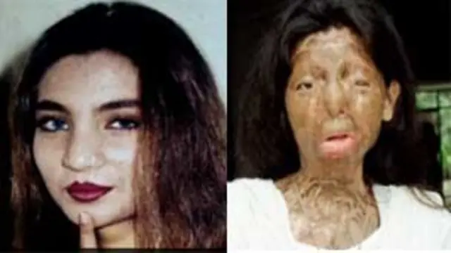 被毁容的巴基斯坦妇女