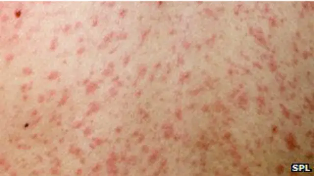 د تېرکال په لومړیو کې د نورستان ولایت په دواب او منډول ولسوالیو کې د شري ناروغۍ له امله د څلوېښتو ماشوماتو د مړینې راپور ورکول شوی و.