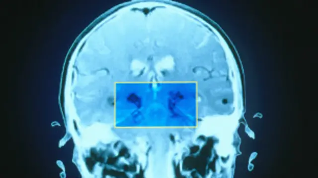 Escáner del cerebro de una persona con la enfermedad de Parkinson