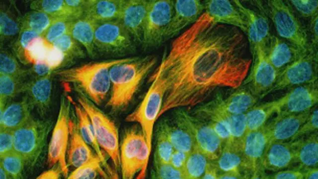 मेलानोमा कैंसर की चपेट में आने का ख़तरा बढ़ रहा है