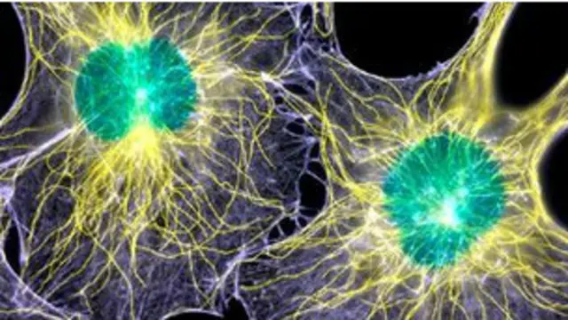 Celulas cancerosas bajo el microscopio