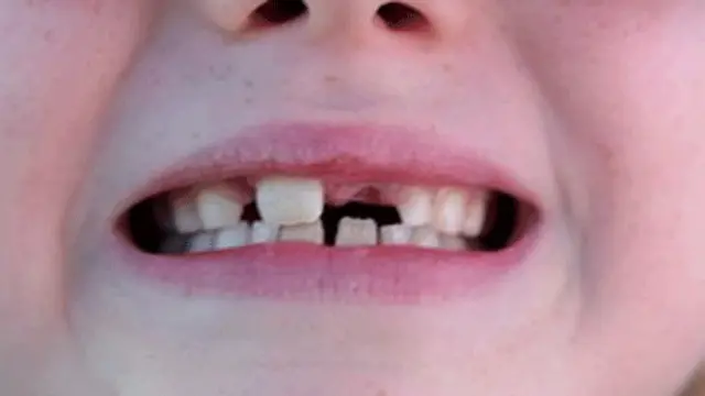 बच्चों के दांतों में सड़न