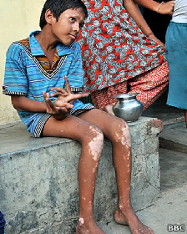 पिछले दिनों इस इलाके में सफ़ेद दाग़ के कई मामले सामने आए हैं. सफेद दाग़ 'मरकरी पॉयज़निंग' का मुख्य भी लक्षण है.