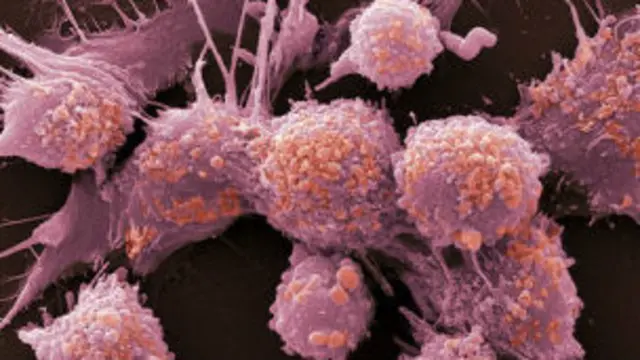 Células cancerosas de próstata