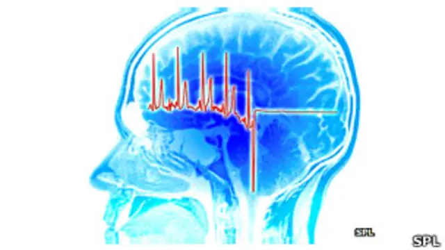 शोध के मुताबिक अमरीका में आज की तारीख में स्ट्रोक से पीड़ित हर पांच में से एक व्यक्ति युवा है.