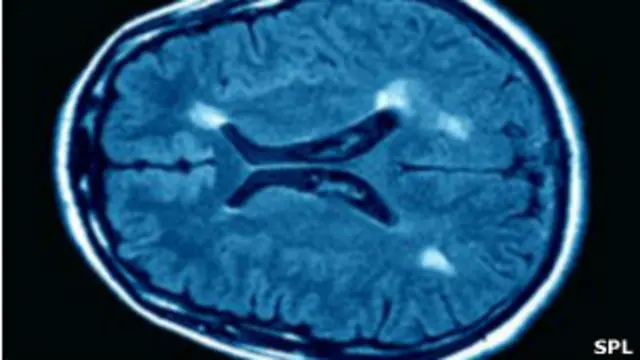 هنوز درمانی برای بیماری ام.اس. پیدا نشده است