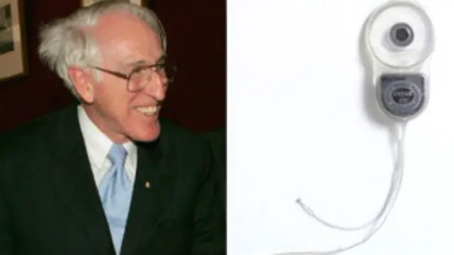  मुक-बधिरों के लिए रामबाण की तरह है कॉक्लिया इंप्लांट