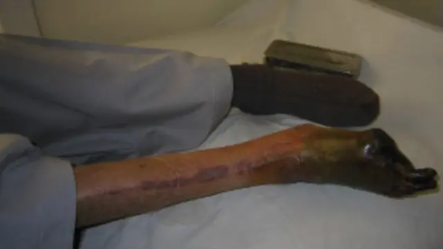 डायबिटीज़