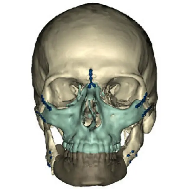 Trasplante de cara de la Universidad de Maryland