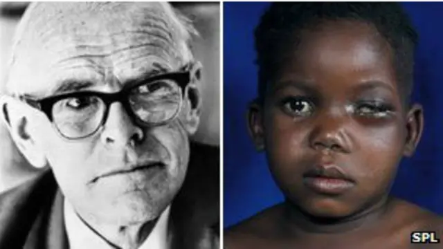 डॉक्टर डेनिस बर्किट ने ही पहली बार इस बीमारी को पहचाना था.