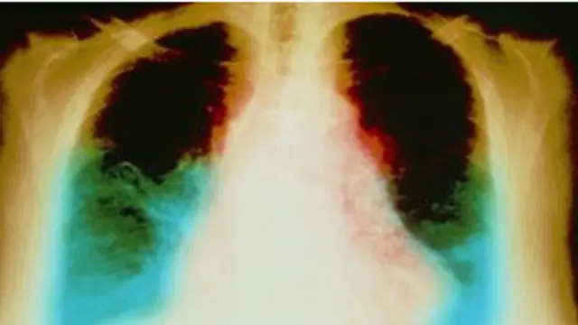 डायबिटीज़