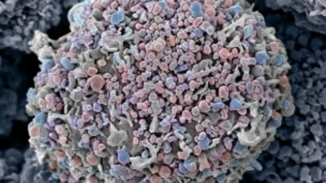 دکتران می گویند یک درصد زنان افغان به سرطان پستان مبتلا هستند