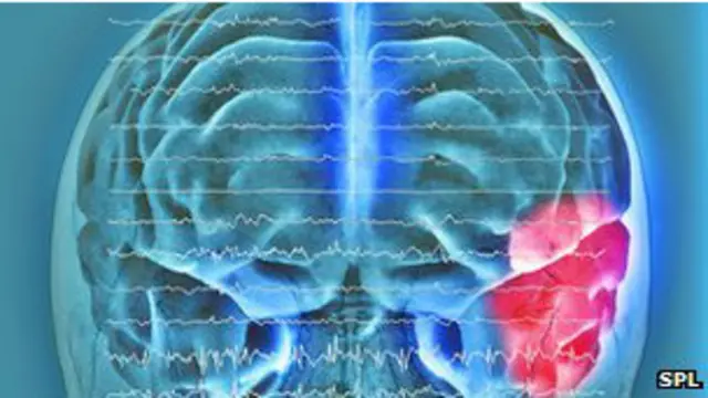 لايزال الصرع احد اكثر الامراض العصبية تفشيا بين الاطفال في بريطانيا.