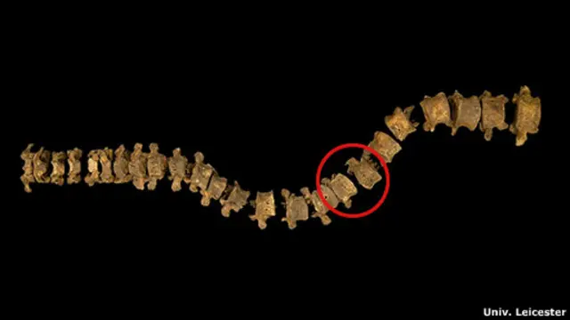 Columna con escoliosis