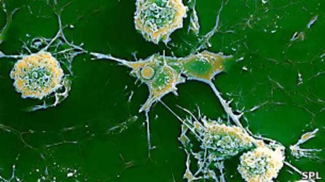 Esclerosis múltiple