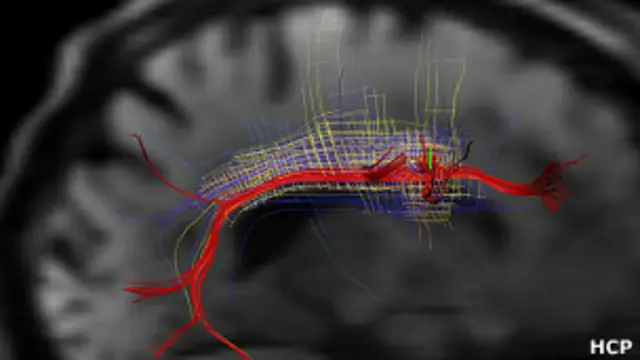 Escáner del cerebro