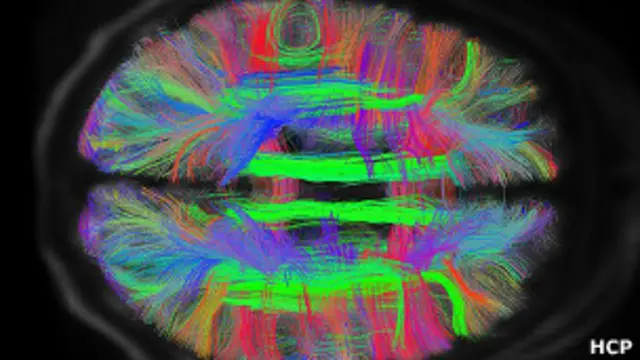 Escáner del cerebro