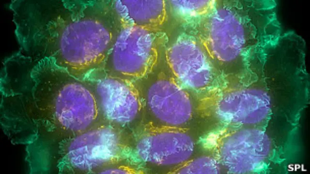 Meme kanseri hücresi