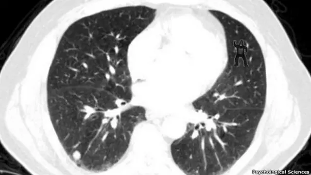 Tomografía de pulmón