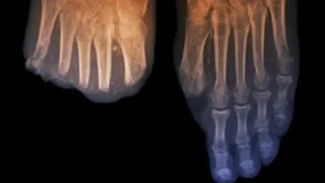 تزداد احتمالات بتر القدم عشرين مرة لدى مرضى السكري أكثر من غيرهم