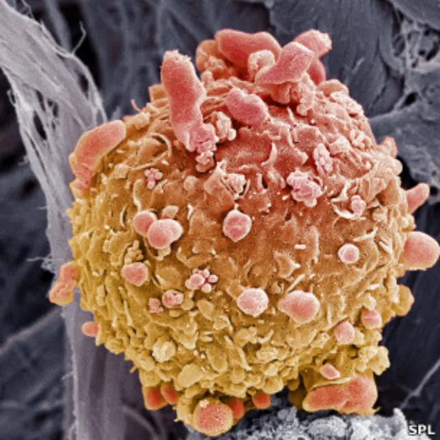 سرطان الجلد 