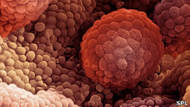 پروسٹیٹ کینسر دنیا کے اکثر ممالک میں مردوں میں عام ہے