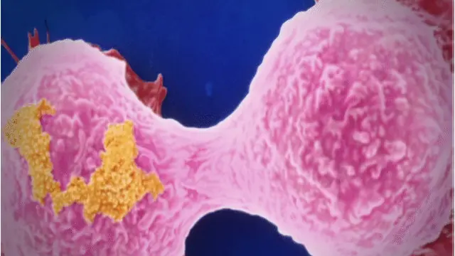 Diyakini, penderuita kanker memiliki "sidik jari" khusus dalam nafasnya