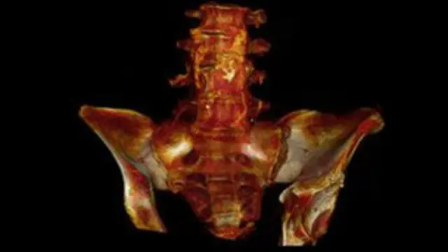 ममी की सीटी स्कैन की रिपोर्ट.