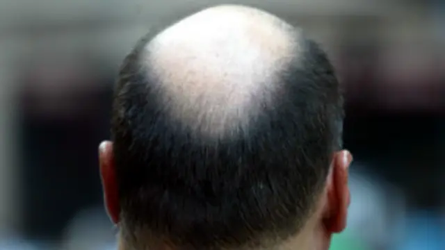 गंजे लोगों में हृदय रोगों का जोखिम धूम्रपान और मोटापे की तुलना में कम है.