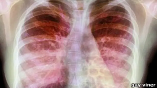 تزايدت الاصابة بالعدوى خلال العقد الماضي