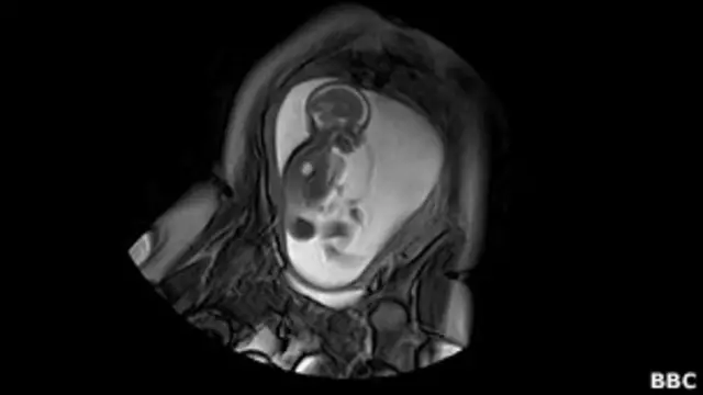 Scanner de bebê ainda no útero - Foto: BBC