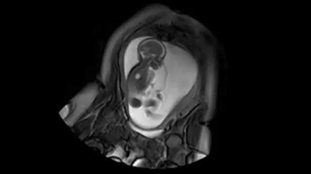 Cérebro do bebê | Crédito: BBC