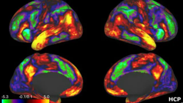 скан мозга на томографе