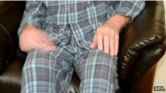 مرض باركنسون