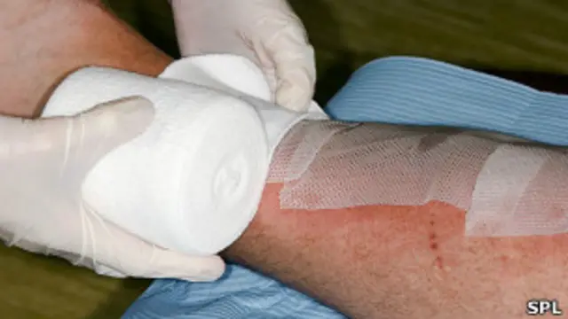 Tratamiento de quemadura